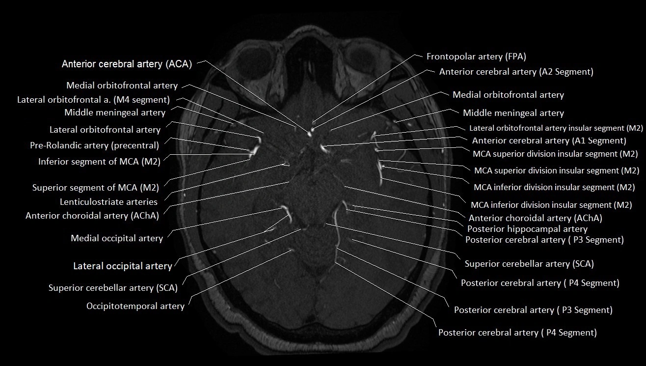 MRA brain (cerebral arteries) anatomy axial 3T image 19.webp